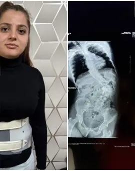 Foto Alexandra are nevoie de sprijinul nostru. 37.400 de euro este preţul unei vieţi normale pentru tânăra de doar 15 ani