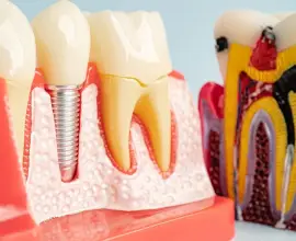 Foto Ce diferențiază implanturile Bredent de alți producători?