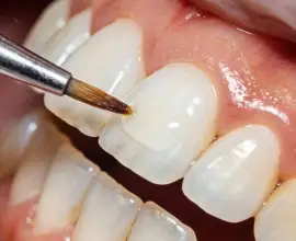 Foto 3 aspecte importante de luat în considerare înainte de a apela la fațete dentare