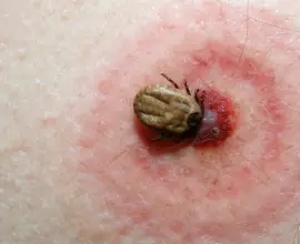 Foto Tot mai multe persoane ajung la spital după mușcături de căpușe 