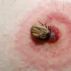 Imagine Tot mai multe persoane ajung la spital după mușcături de căpușe 