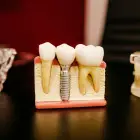Foto Cât de dureroasă este procedura de implant dentar?