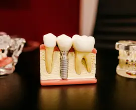 Foto Cât de dureroasă este procedura de implant dentar?