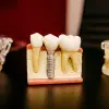 Imagine Cât de dureroasă este procedura de implant dentar?